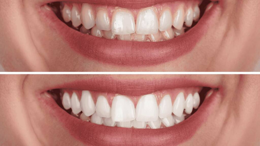 Onde Fazer Clareamento Dental em Porto Alegre