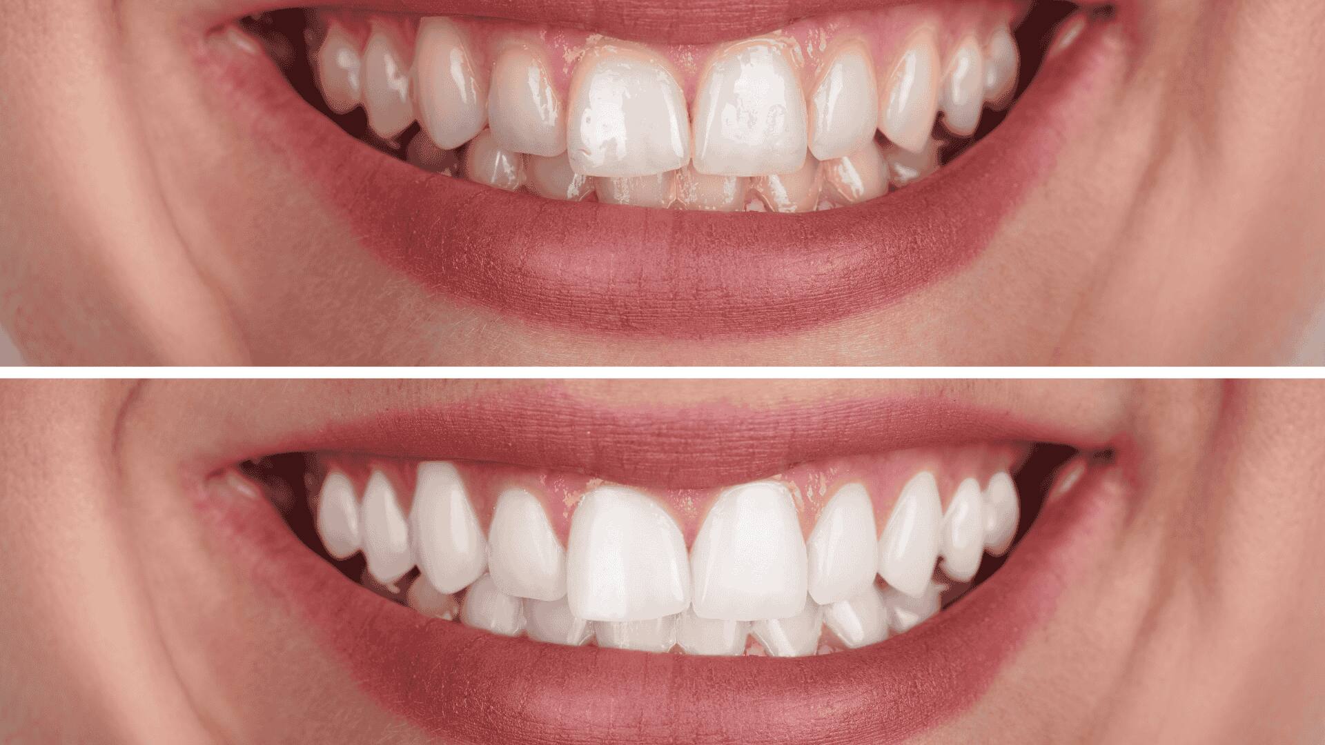 Onde Fazer Clareamento Dental em Porto Alegre