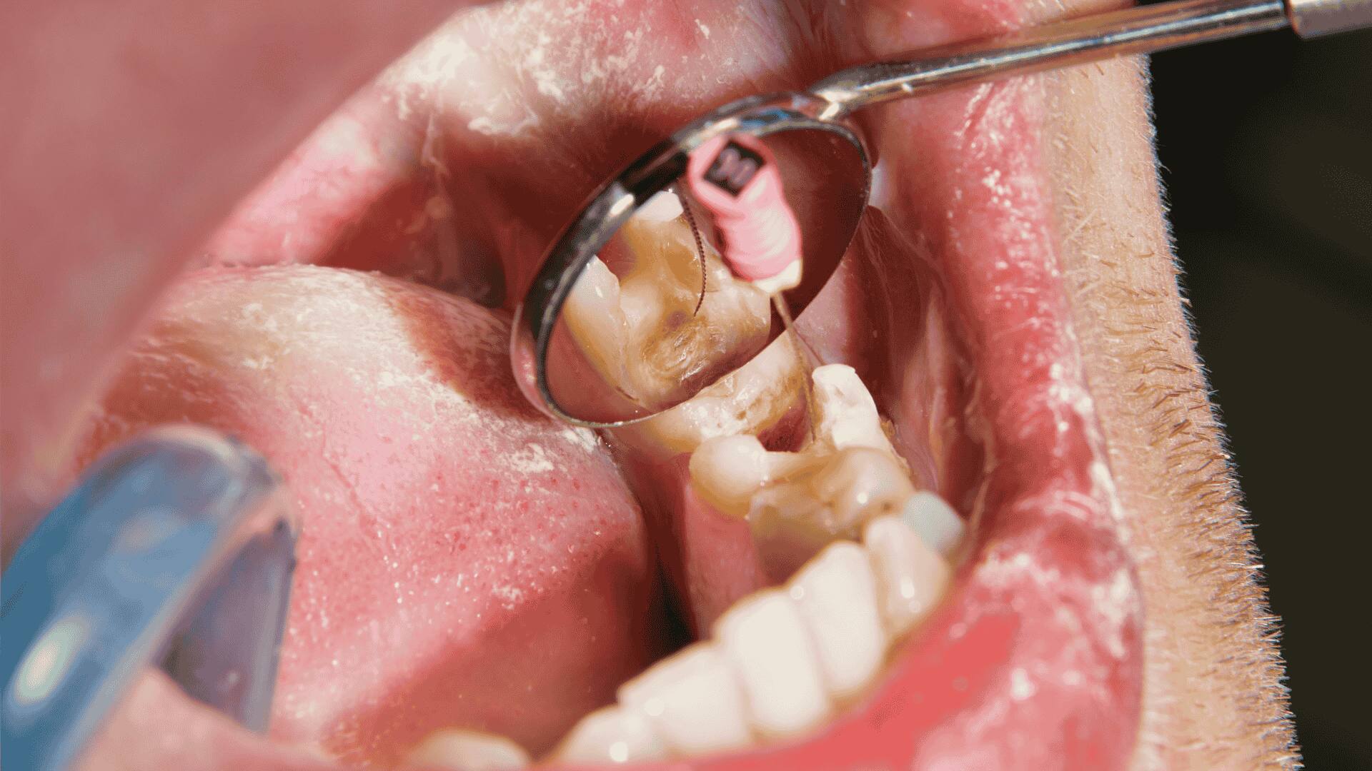 Encontre o melhor dentista para tratamento de canal em Porto Alegre. Agende sua consulta e cuide da sua saúde bucal com a Clínica Dental Center.